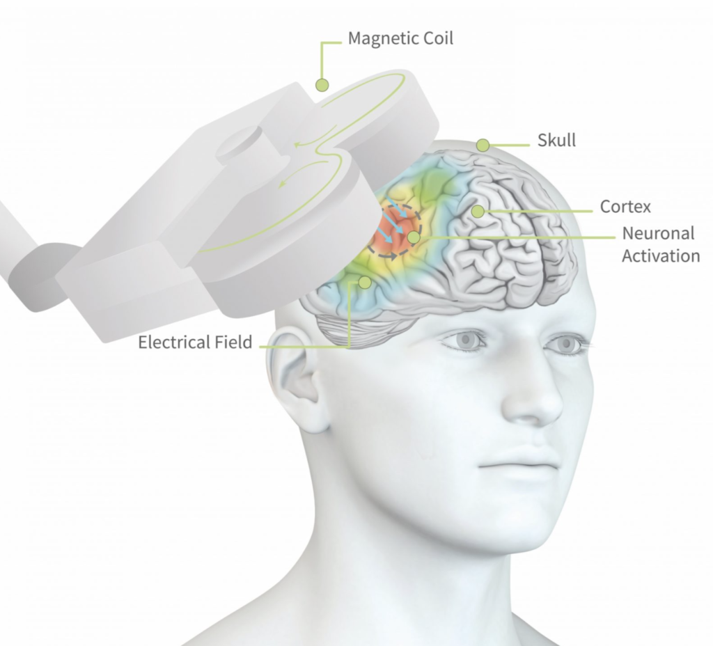 rTMS: Durchführungsweise und Anwendungsgebiete